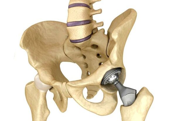 Endoprostetics of hip combination
