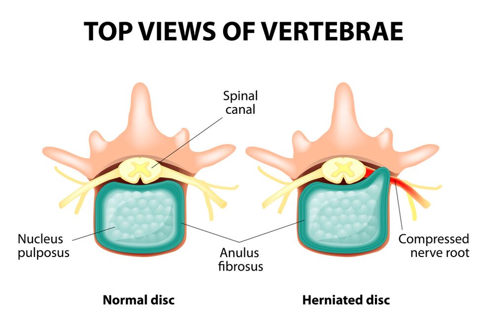Healthy intervertebral disk and hernia