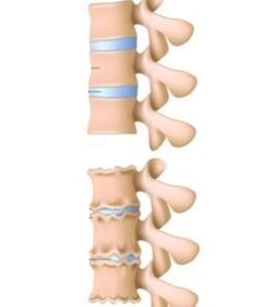 Reasons for osteocondrosis