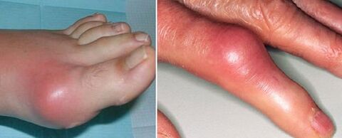 The appearance of joints with arthritis