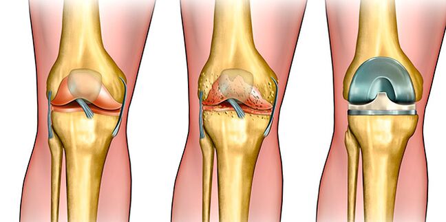 In the third stage of arthrosis, knee replacement is required