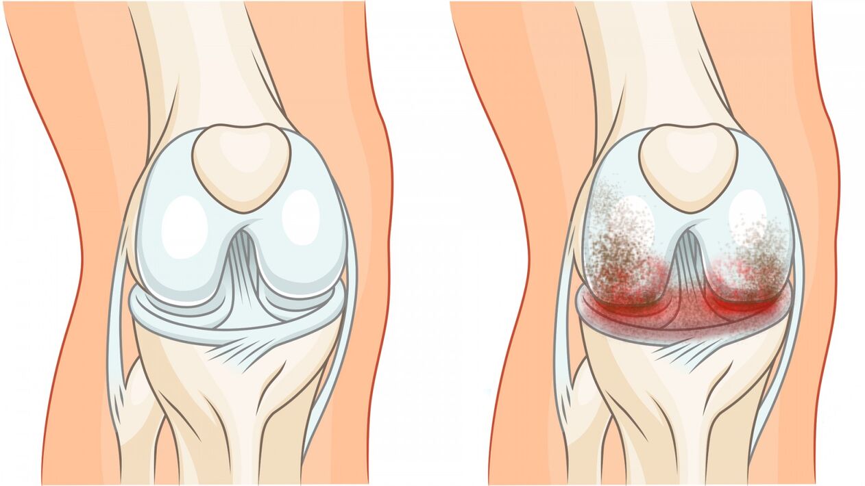 arthrosis of healthy joints and knee joints