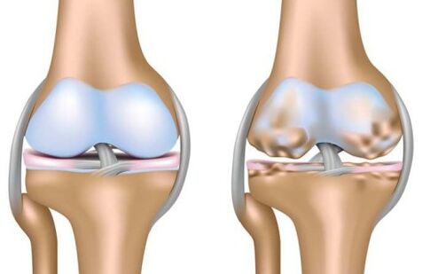 destruction of healthy joints and knee joints in osteoarthritis