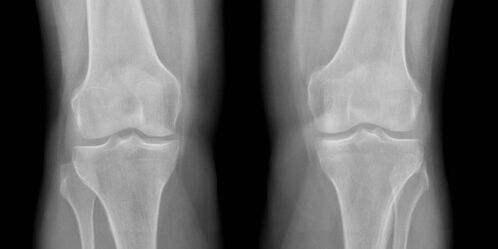 radiography of knee osteoarthritis