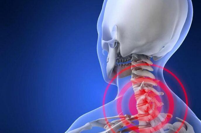 Burning pain in the neck - an early symptom of cervical osteochondrosis