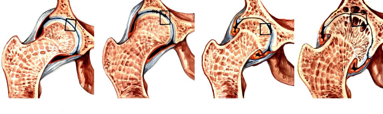 Deformation degrees of coxarthrosis