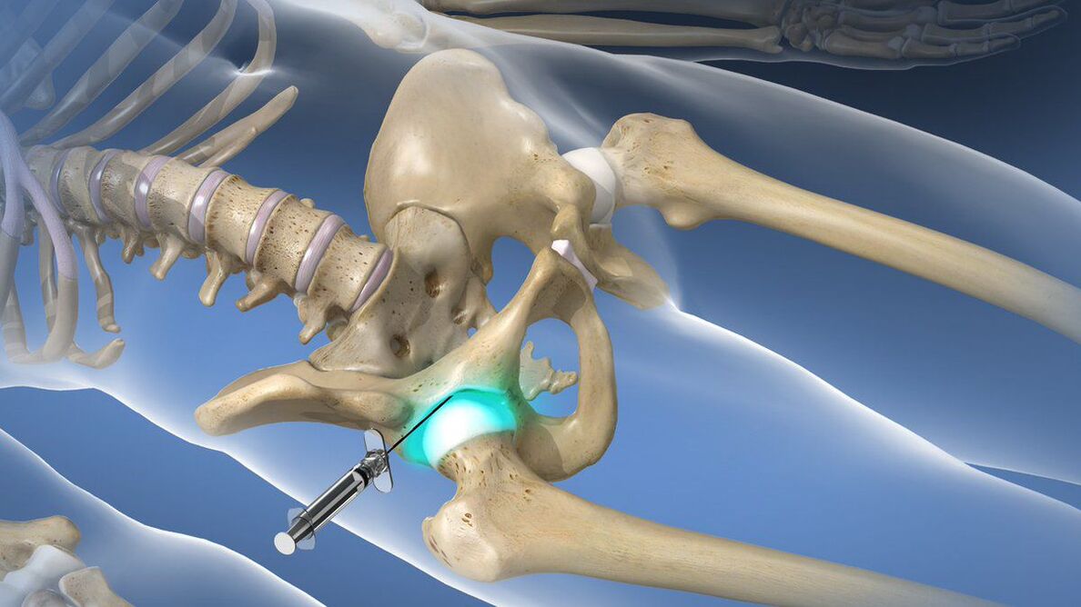 Intra-articular blockade to relieve acute pain in coxarthrosis