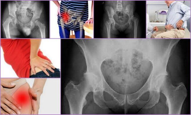 Pain and limited mobility are the main symptoms of hip osteoarthritis