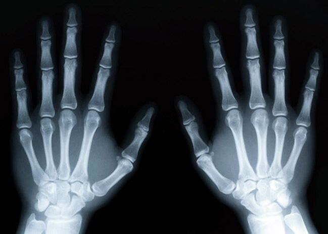 Gout leads to the development of gouty arthritis, which can be diagnosed using X-rays. 