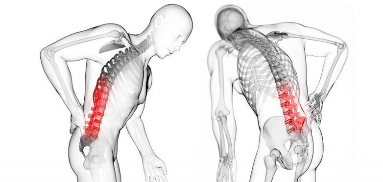 complications with cervical osteochondrosis