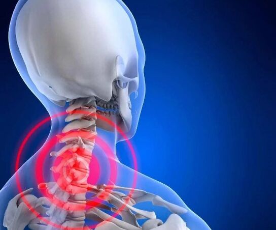 Cervical osteocondrosis