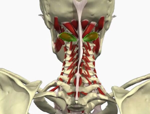 Vail Artyy syndrome